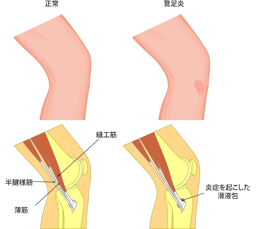 鵞足炎の図解解説