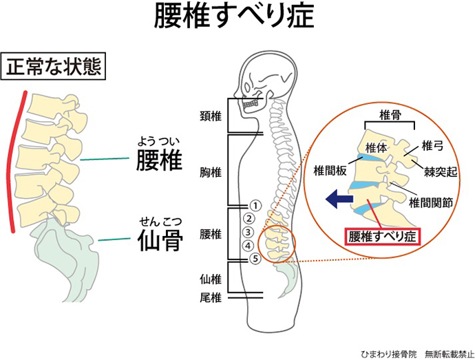 ひまわり接骨院の腰椎すべり症解説図