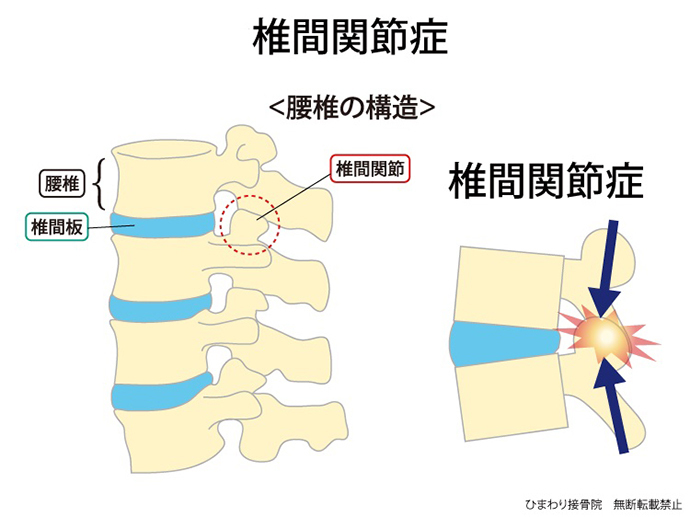 椎間関節症（椎間関節性腰痛）の解剖図