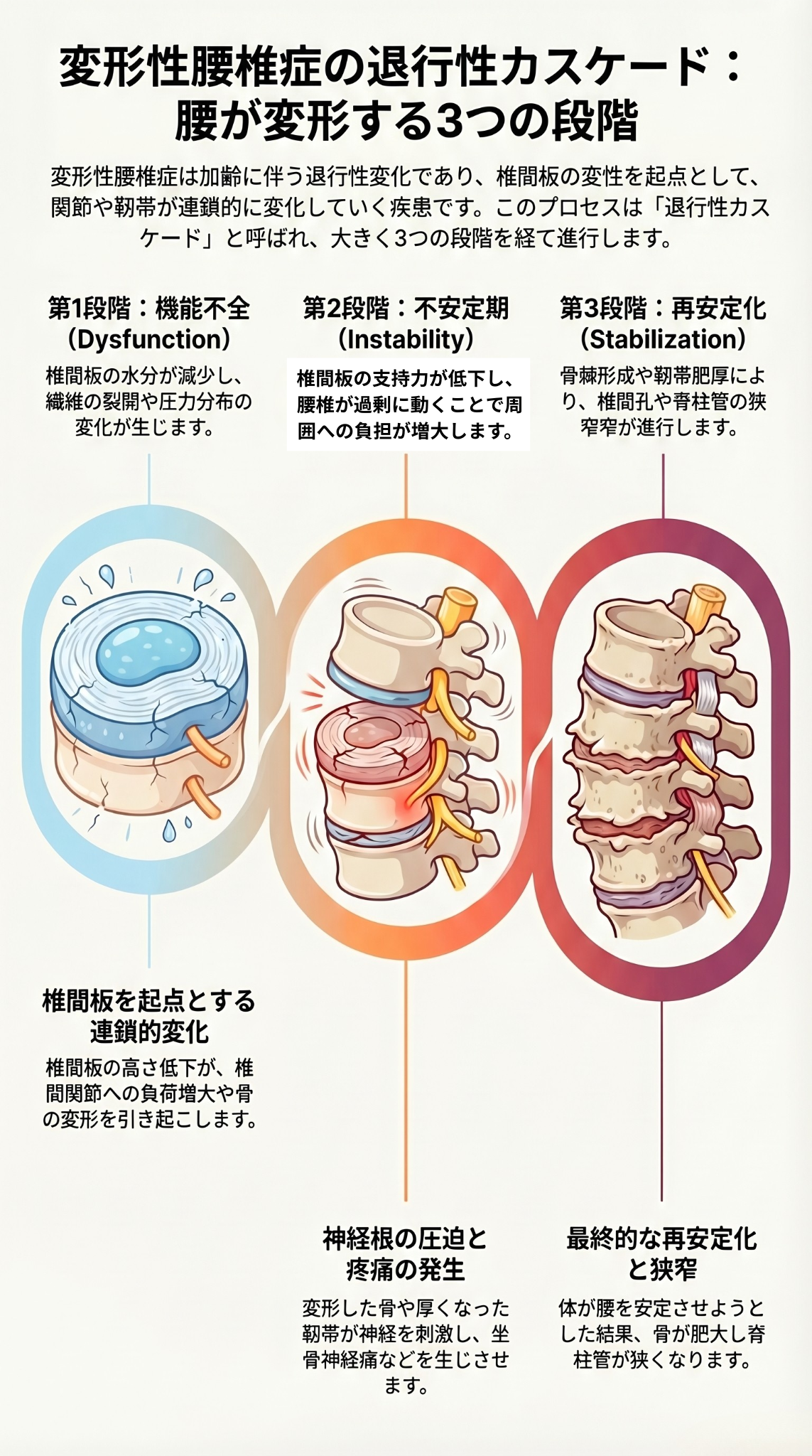変形性腰椎症の退行性変化の図解