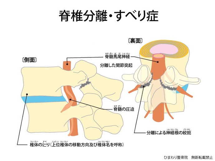 ひまわり接骨院の脊椎分離・すべり症解説図