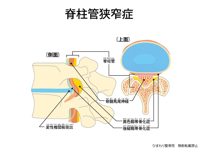 ひまわり接骨院の腰部脊柱管狭窄症解説図
