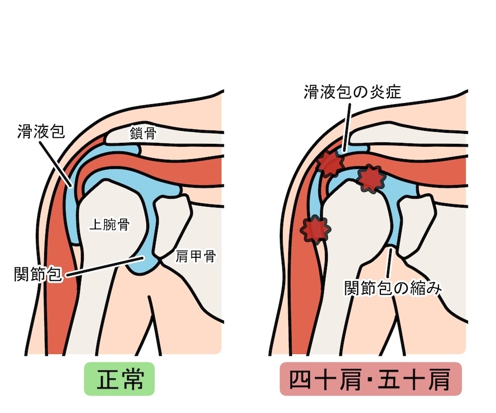 四十肩・五十肩と健常者の違いを示す図解