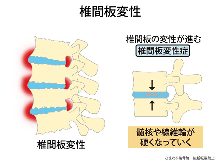 ひまわり接骨院の椎間板変性解説図