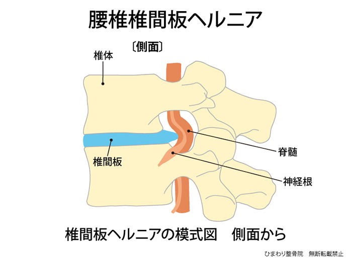 ひまわり接骨院の腰椎椎間板ヘルニア解説図