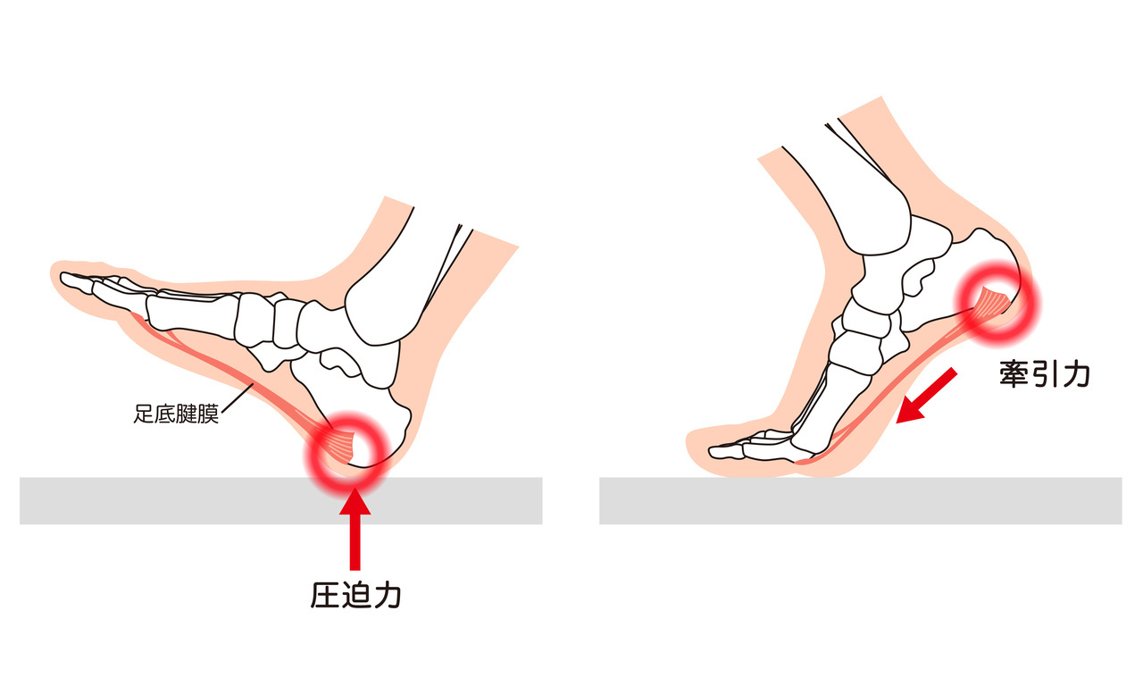 足底筋膜炎の発生機序