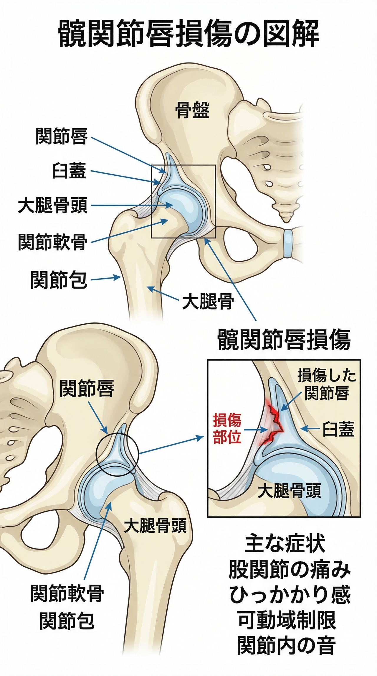 股関節の関節唇損傷の図