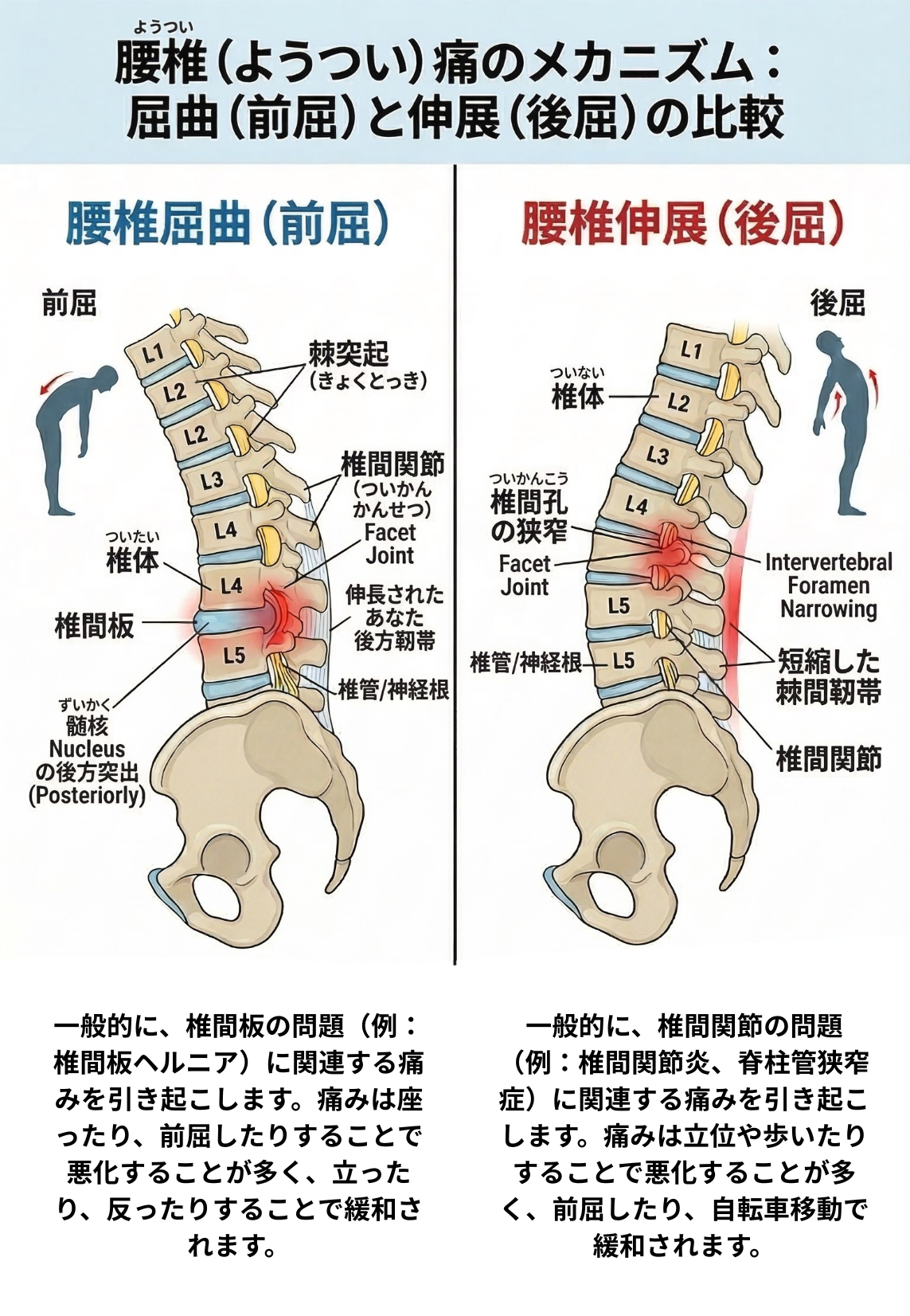 伸展型腰痛と屈曲型腰痛のメカニズムクワーク