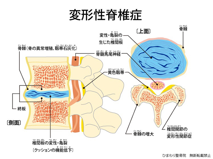 ひまわり接骨院の変形性脊椎症解説図
