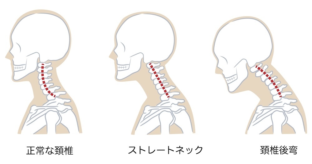 ストレートネックの図解説明