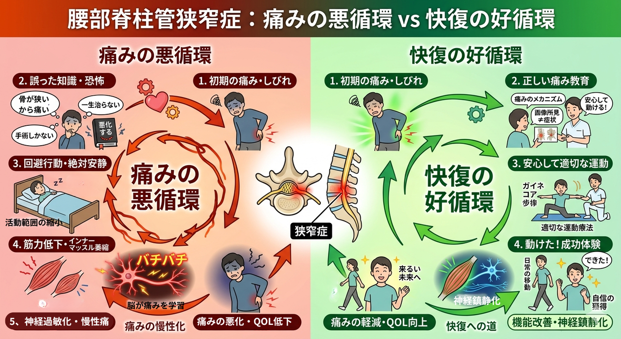 腰部脊柱管狭窄症：痛みの悪循環VS回復の好循環