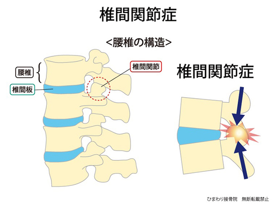 椎間関節症（椎間関節性腰痛）の解剖図