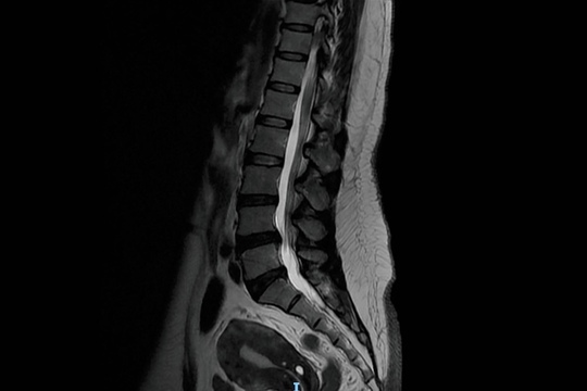 脊柱管狭窄症のMRI画像