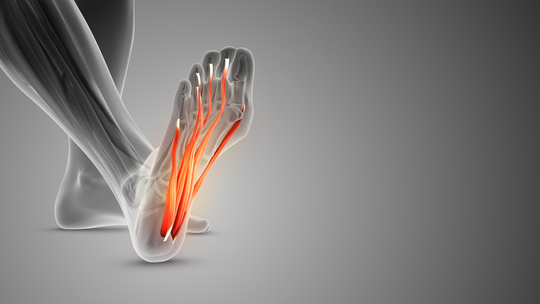 足底筋膜炎のイメージ画像