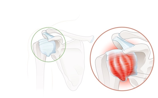 五十肩の解剖図