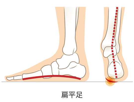 扁平足の説明画像