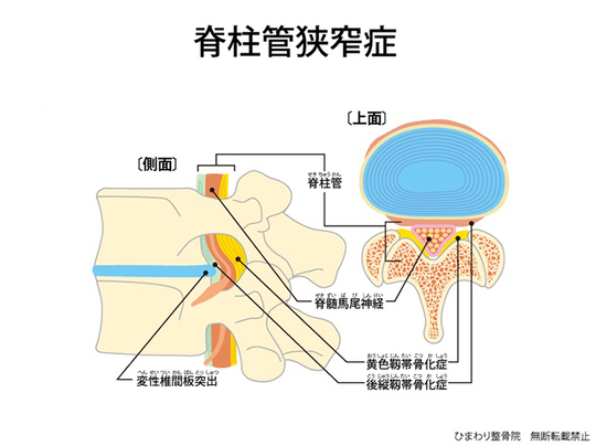 ひまわり接骨院の脊柱管狭窄症解説図