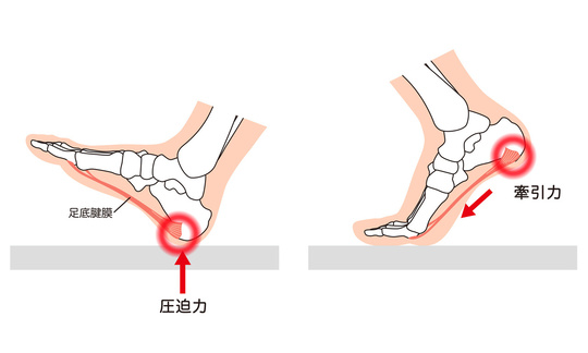 足底筋膜炎の発生機序