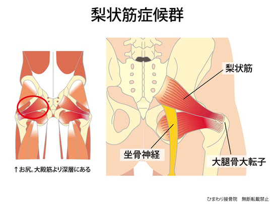 梨状筋症候群の解剖図