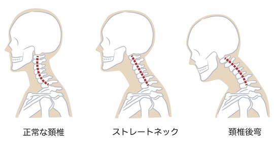 ストレートネックの図解説明